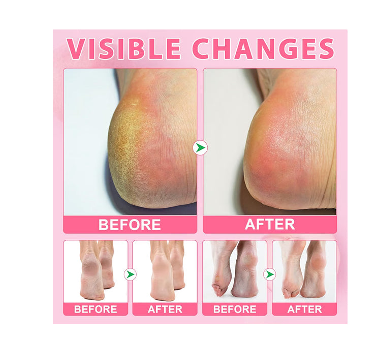 Chenyayun
Urea Cream 60% Plus Salicylic Acid 2% Intensive Foot Repair Balm Stick for Dry Cracked/Chapped Heel/Hands Intensively Moisturization, Callus Removal/Softening/Soothing-Peach Scent.40 G..
